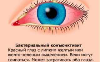 Бактериальный конъюнктивит