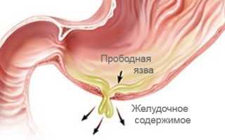 Прободная язва желудка