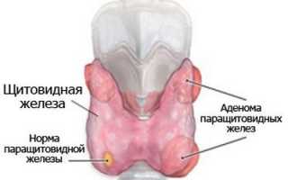 Аденома паращитовидной железы