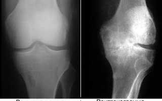 Деформирующий остеоартроз