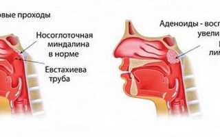 Гипертрофия аденоидов