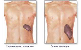 Боль в левом подреберье