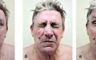 Блефароспазм