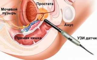 УЗИ простаты (ультрасонография)