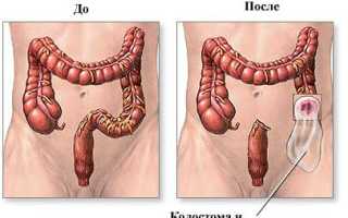 Болезнь Шагаса