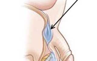 Киста семенного канатика
