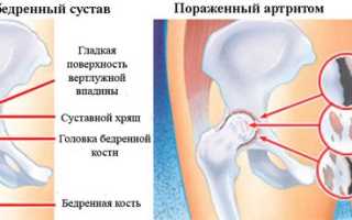 Артрит тазобедренного сустава