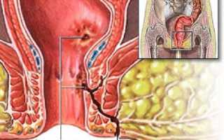 Свищ прямой кишки