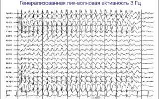 Абсанс