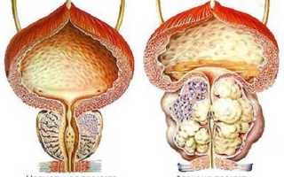Аденома простаты