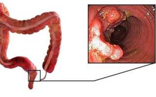 Аденокарцинома кишечника