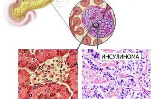 Инсулинома