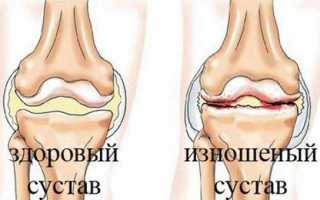 Остеохондроз коленного сустава