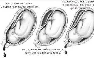 Отслойка плаценты