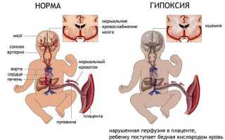 Плацентарная недостаточность