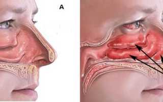 Гнойный ринит