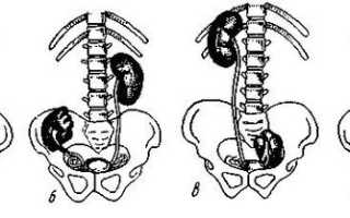 Дистопия почки