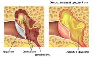 Экссудативный отит