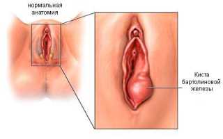 Абсцесс бартолиновой железы