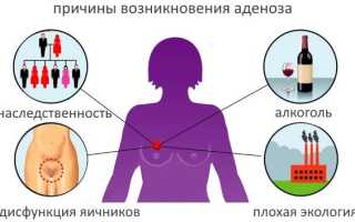 Аденоз молочной железы