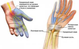 Парестезия
