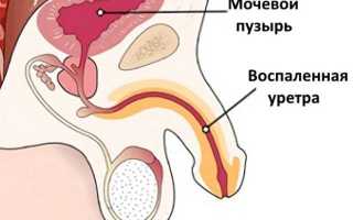 Уретрит у мужчин