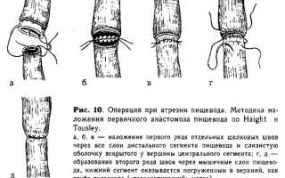 Атрезия пищевода