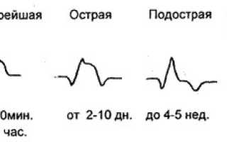 Инфаркт миокарда