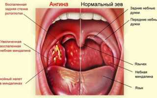 Воспаление горла