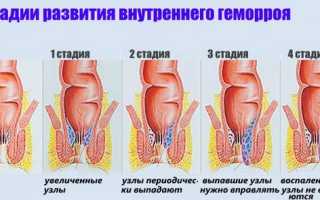 Внутренний геморрой