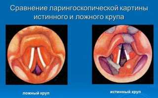 Ложный круп
