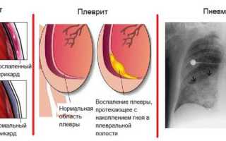 Синдром Дресслера