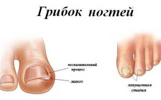 Ногтевой грибок  — причины возникновения и самые эффективные способы лечения