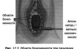 Вестибулит