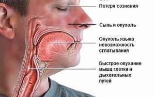 Анафилактический шок