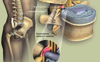 Грыжа поясничного отдела позвоночника