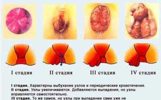 Геморрой при беременности