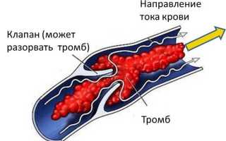 Тромбоз