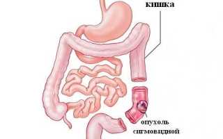 Рак сигмовидной кишки