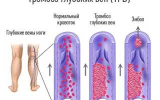 Тромбоз глубоких вен