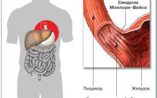 Синдром Меллори-Вейсса
