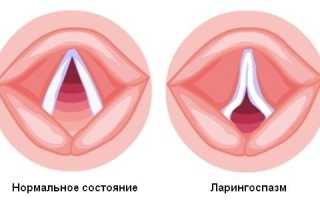 Спазм в горле