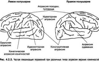 Апраксия