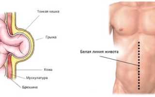 Грыжа белой линии живота