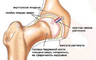 Дисплазия тазобедренного сустава