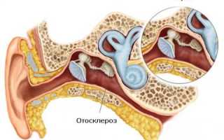 Отосклероз (отоспонгиоз)
