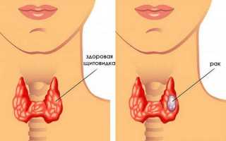 Папиллярная карцинома