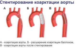 Коарктация аорты