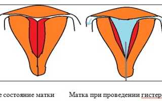 Гистероскопия