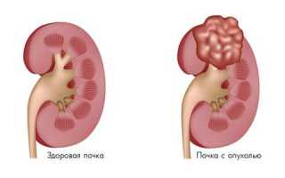Ангиомиолипома